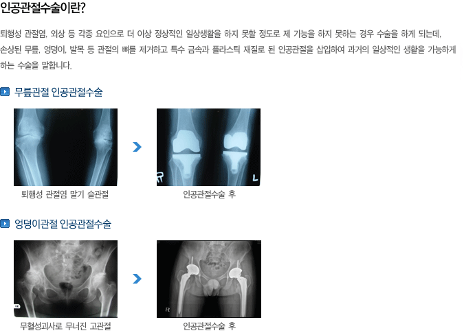 인공관절수술이란?