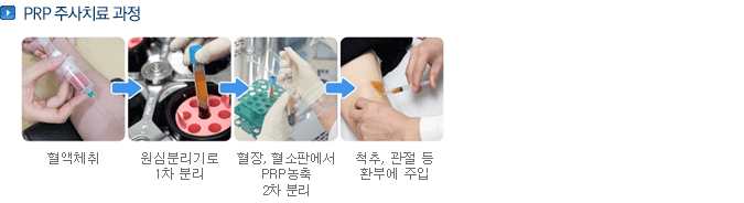PRP 주사치료 과정